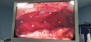 40 yr female presented with incisionsal hernia after LSCS. Her hernia was repaired with laparoscopic intraperitoneal mesh